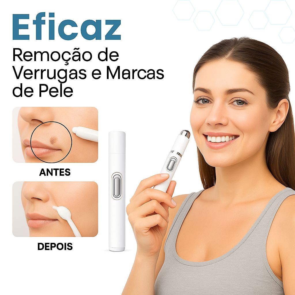Caneta Laser MediSkin™ – Remove Manchas e Verrugas sem Dor