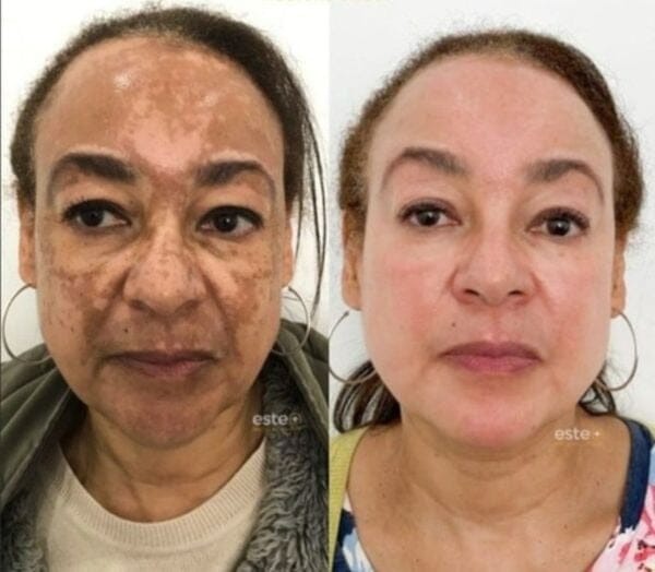 Revitta 577 Spray - Remove manchas de SOL, IDADE E MELASMA!