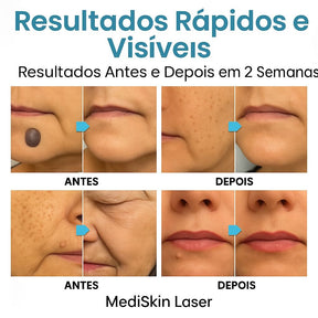 Caneta Laser MediSkin™ – Remove Manchas e Verrugas sem Dor