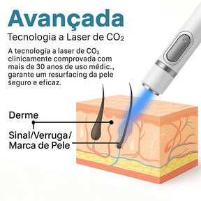 Caneta Laser MediSkin™ – Remove Manchas e Verrugas sem Dor