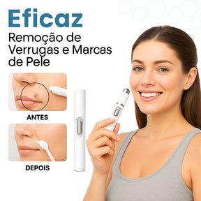 Caneta Laser MediSkin™ – Remove Manchas e Verrugas sem Dor