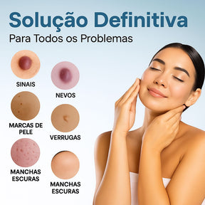 Caneta Laser MediSkin™ – Remove Manchas e Verrugas sem Dor