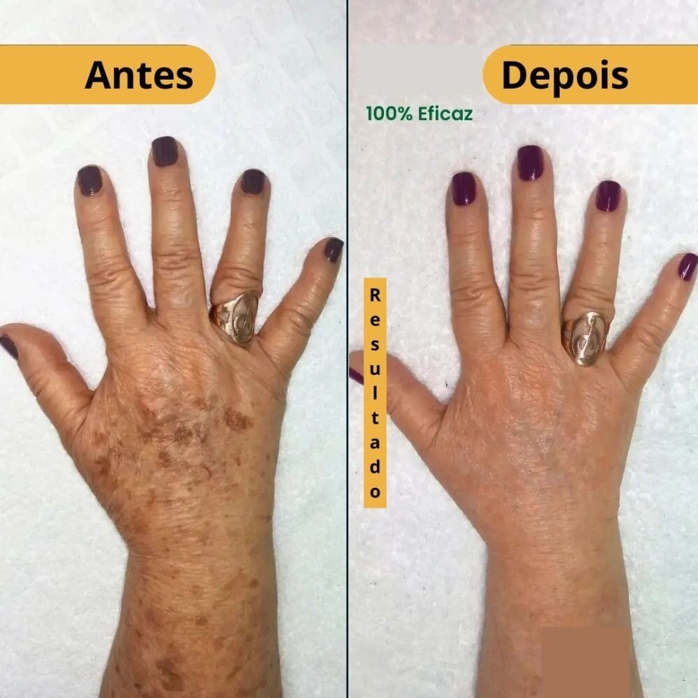 Revitta 577 Spray - Remove manchas de SOL, IDADE E MELASMA!