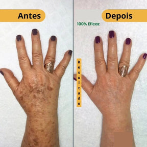 Revitta 577 Spray - Remove manchas de SOL, IDADE E MELASMA!