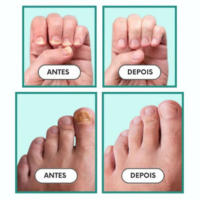 Unha Livre PRO – Solução Avançada para Unhas Saudáveis