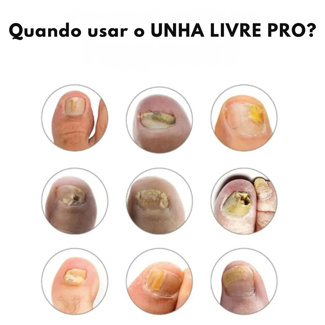 Unha Livre PRO – Solução Avançada para Unhas Saudáveis